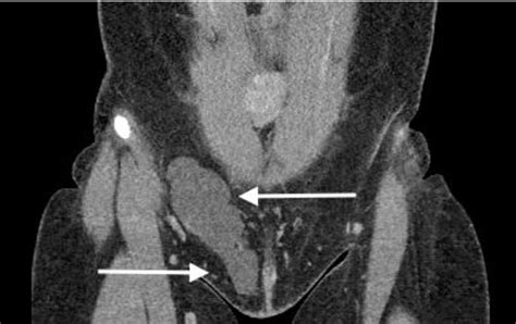 Hydrocele In Women