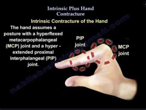 Basic Principles Of Splinting And Introduction To Static Splinting