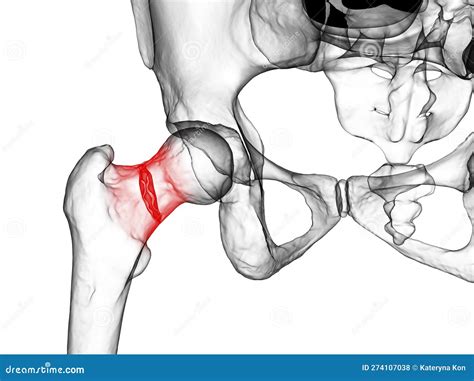 Fracture Of The Femur - Breakpoints - 3D Rendering Stock Photo ...