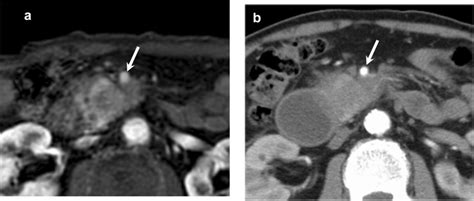 A 70 Year Old Man With Pancreatic Ductal Adenocarcinoma At