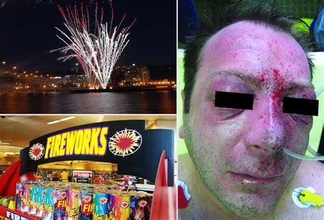 Fireworks Injuries Ooh Aah Ouch