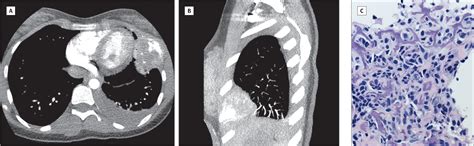lung opacification radiology jama jama network