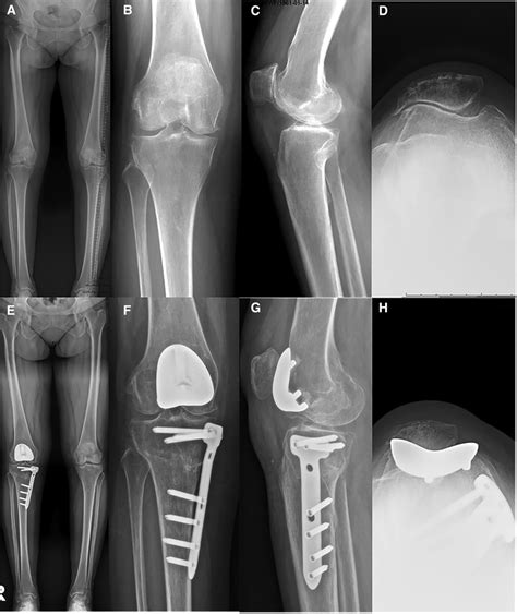 Frontiers Patellofemoral Arthroplasty In Combination With High Tibial