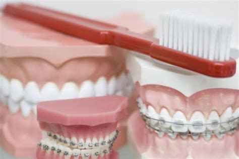 Perfecting Your Smile How To Choose Dental Braces Read Now