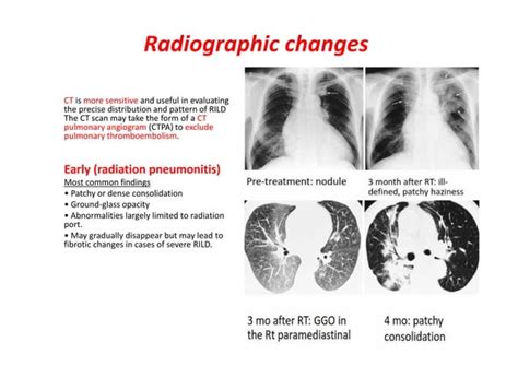 Radiation Pneumonitis | PPT