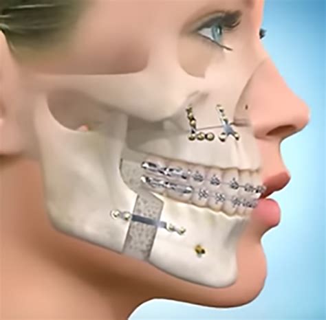 Cirurgia Ortognática Tudo o Que Você Precisa Saber Clínica Ceconi