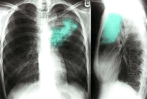 Pneumonia Healthy Lungs Xray - Goimages Urban