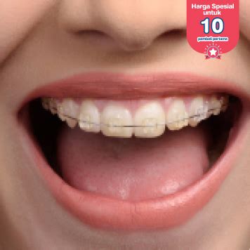 Pasang Behel Sapphire Oleh Drg Spesialis Ortodontik Di Klinik Tooth