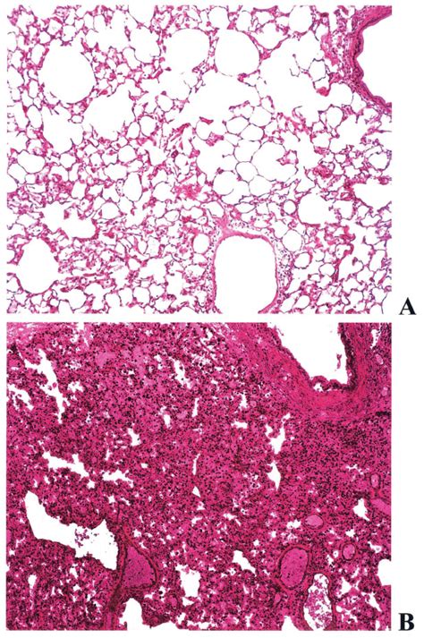 A Hematoxylin And Eosin Staining For Cotransfected Treated Lungs