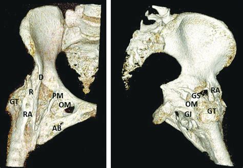 A New Classification Of Peri Articular Heterotopic Ossification Of The Hip Associated With