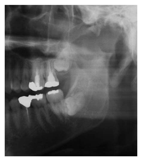 Bone Resorption From Left Fossa To Condyle In Panorama Radiograph