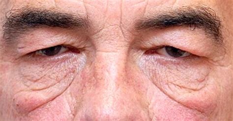 Eye Bags Types Causes And Treatment Premier Clinic