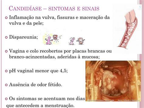 O Que Causa Candidíase - Causas Da Candidíase: Fatores Que Podem Levar À Infecção – WMPVD