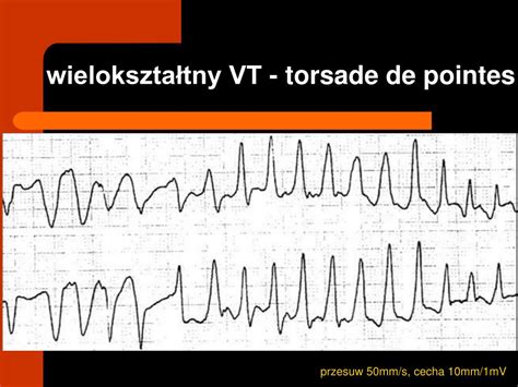 Ppt Kardiomiopatie Zaburzenia Rytmu Serca Powerpoint Presentation