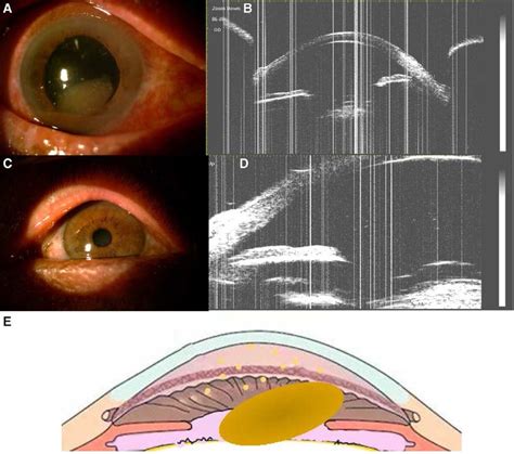 Slit Lamp 16 Magnification And UBM 40 Magnification Images And A