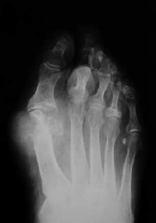 Gout : The Truth: Laboratory Investigations