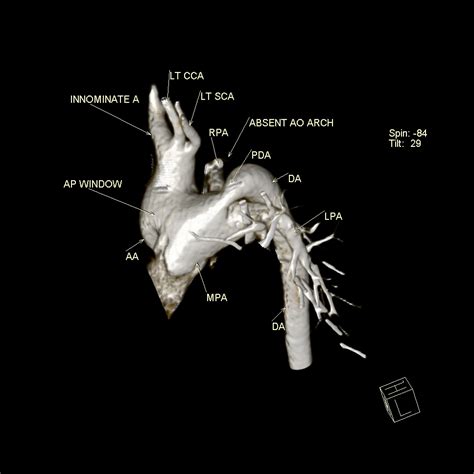 File Aortopulmonary Window Interrupted Aortic Arch And Large Pda