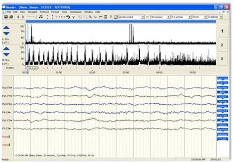 Nicolet Icu Monitor Cephaloneu