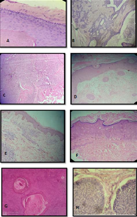 Figure 1 From Spectrum Of Neoplastic And Non Neoplastic Skin Lesions A