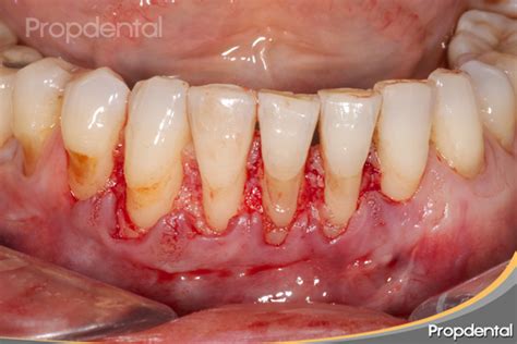 Injerto Periodontal De Tejido Conectivo