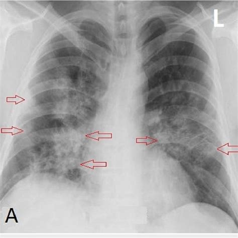 During Admission Chest X Ray A Showed Bilateral Groundglass