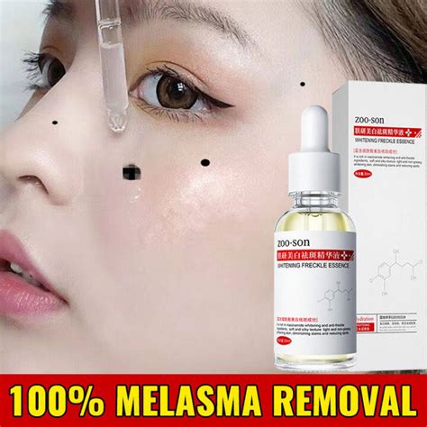 Niacinamide Serum Melasma Removal Serum Dark Spot Removal Facial