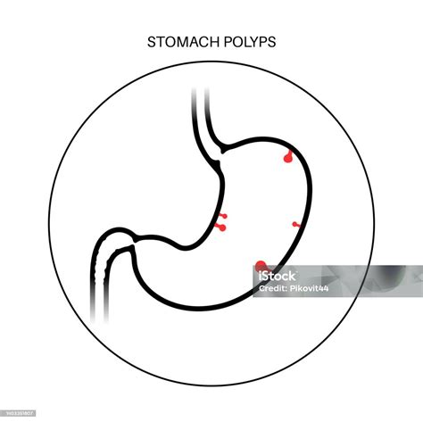 Penyakit Polip Lambung Ilustrasi Stok Unduh Gambar Sekarang Adenoma