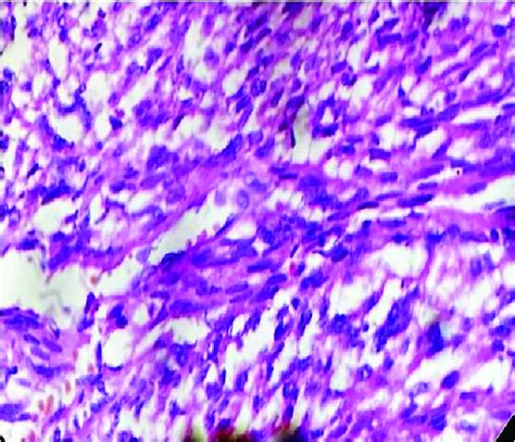 Spindle Shape Tumor Cells With High Cellularity Pleomorphic