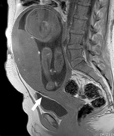 Adjacent Organs To The Placenta Sagittal T1 W Mr Image Shows A Thin Download Scientific