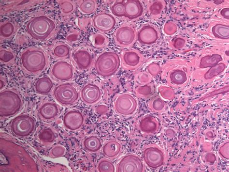 Meningioma w/ psammoma bodies (calcifications surrounded by collagen ...