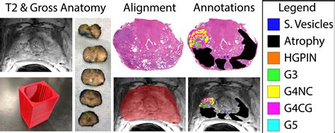 Figure 1 From T2 Weighted Mri Radiomic Features Predict Prostate Cancer