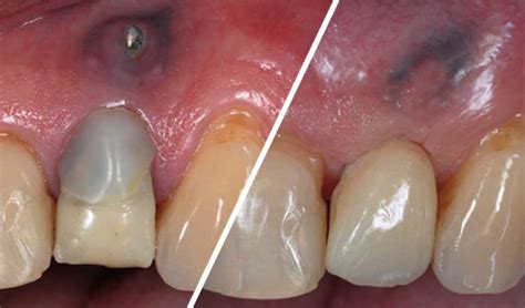 Early Implant Placement Using A Megagen Anyridge Implant Megagen