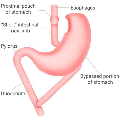 Roux En Y Gastric Bypass Roux Limb