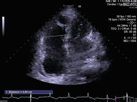 Transthoracic Echocardiography Significant Right Ventricle And Right Download Scientific