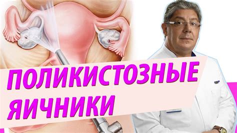 Поликистозные яичники. Синдром Штейна Левенталя - YouTube