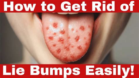 Quick Fixes How To Get Rid Of Lie Bumps Easily Youtube