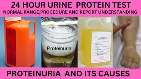 24 HOUR PROTEIN TESTIN URINE NORMAL RANGE PROCEDURE AND REPORT 24 HOUR