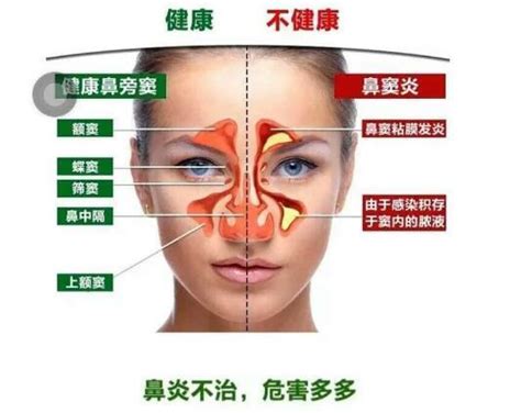 10年鼻窦炎患者 自述康复过程 知乎