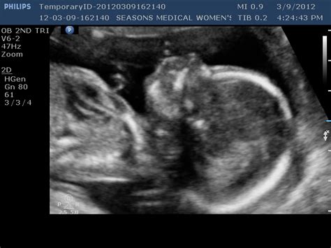 And this is my Joy: 17 weeks and an early ultrasound...