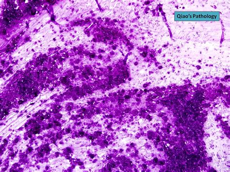 Qiaos Pathology Mucinous Cystadenoma Of Appendix With Numerous