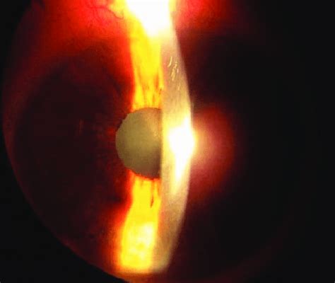 Anterior Uveitis With Conjunctival Injection And Keratic Precipitates