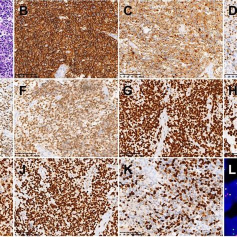 Histopathological Results In Case 1 A Hematoxylin Eosin He