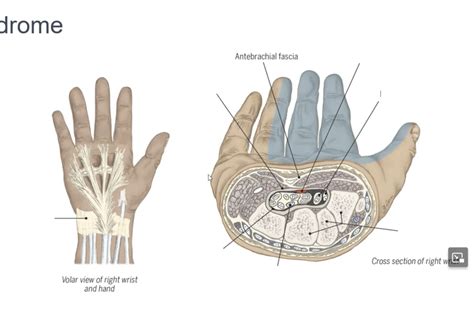 Carpal Tunnel Syndrome Diagram 1 Diagram Quizlet