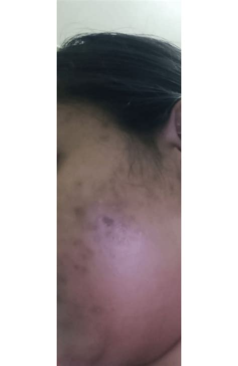 Will Tretinoin Help These Scars Rtretinoin