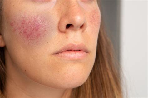 Comprehensive Guide To Mild Rosacea Remotederm