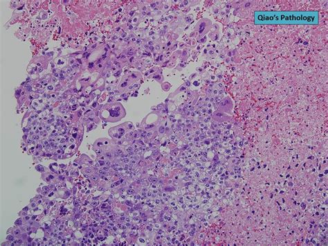 Qiaos Pathology Testicular Choriocarcinoma A Photo On Flickriver