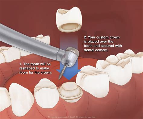 Dental Crown - Los Algodones, Baja California - Dr. Valenzuela