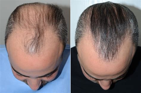 Hair Transplants For Men Photos Miami Fl Patient59522