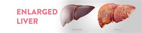 Enlarged Liver Symptoms