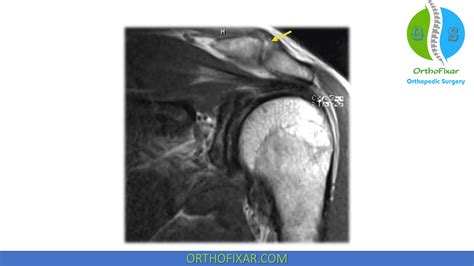 Ac Joint Arthritis | OrthoFixar 2024